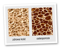 Osteoporoza - różnica w budowie kości